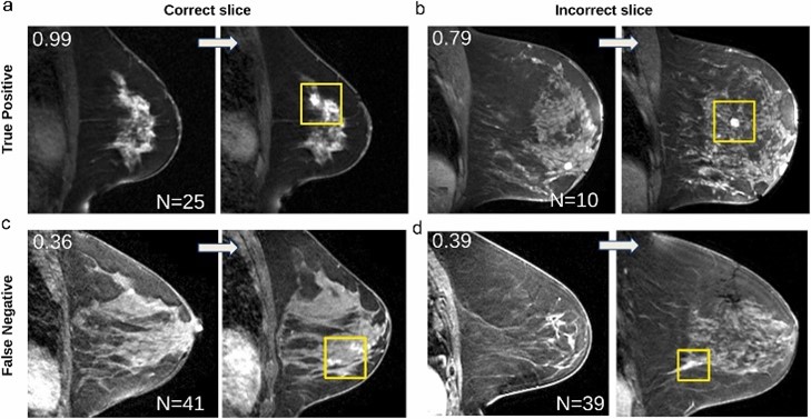 Can AI Improve Early Detection of Breast Cancer in MRI Studies? - Radparts